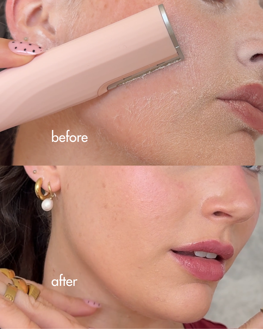 Ultrasonic Dermaplaner